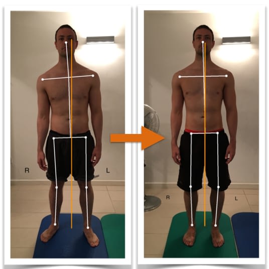Client A's front view body alignment before and after Posture Correction Therapy.