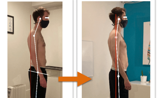 Before and after photos showing remarkable improvement of a man's body alignment from side view after posture correction therapy