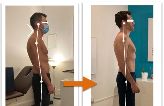Before and after photos showing good improvement of a man's body alignment from side view after posture correction therapy