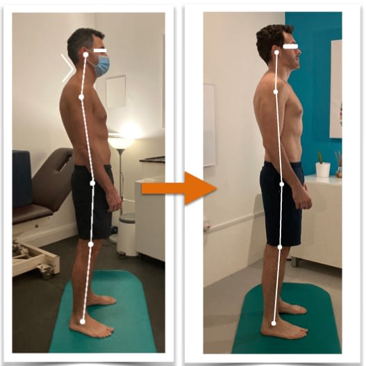 Before and after photos showing good improvement of a man's body alignment from side view after posture correction therapy