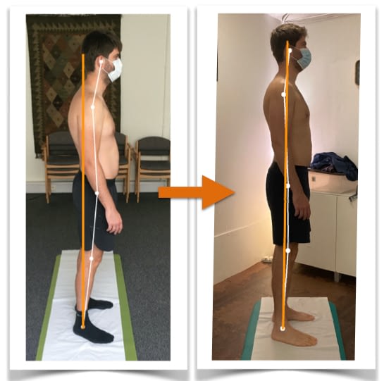 Client Gs body alignment before and after Posture Correction Therapy