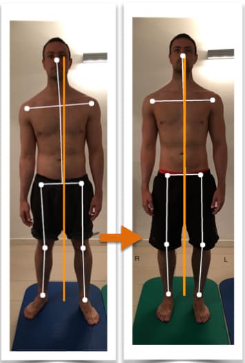 Before and after photos showing improvement of a man's body alignment from front view after posture correction therapy