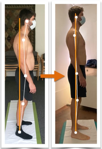 Before and after photo showing massive improvement of a man's body alignment from side view after posture correction therapy
